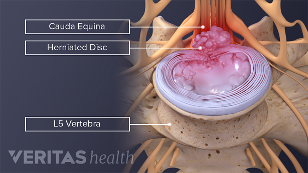 A severely herniated disc pressing on the cauda equina nerves in the lower spine.