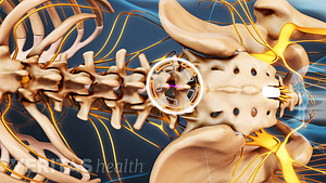 Medical illustration of the lumbar spine showing the location of a microdiscetomy