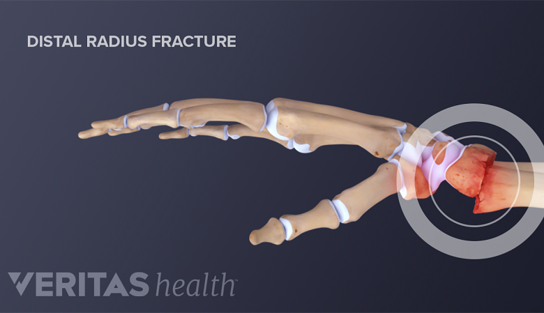 A distal radius fracuture occurs when the there is a break in the wrist end of the radius bone.