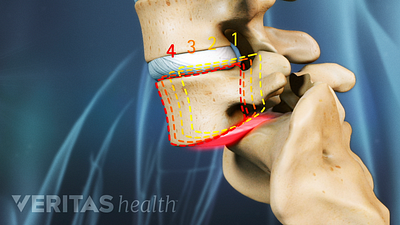 Profile view of the lumbar spine showing grade 4 spondylolisthesis of the L5 over the sacrum.