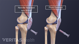 Medical illustration showing the impact of draining fluid from a bursa