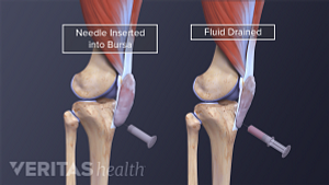 Illustration of knee bursa being drained
