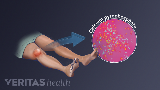 Illustration of knee swelling from pseudogout caused by calcium pyrophospate