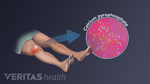 Calcium pyrophosphate crystals in the joints causing pseudogout