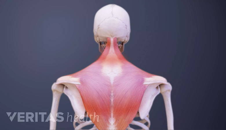Illustration showing posterior view of stiff neck muscle.