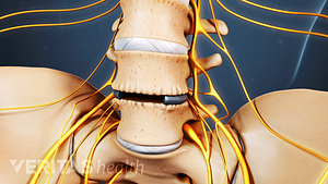 Vista anterior de la columna lumbar con material discal extraído.