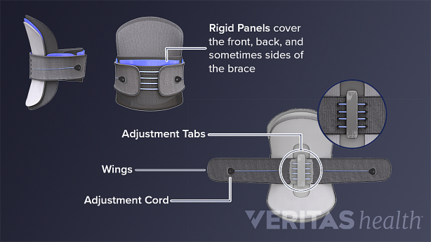Medical illustration of a rigid brace and the different parts of the brace highlighted.