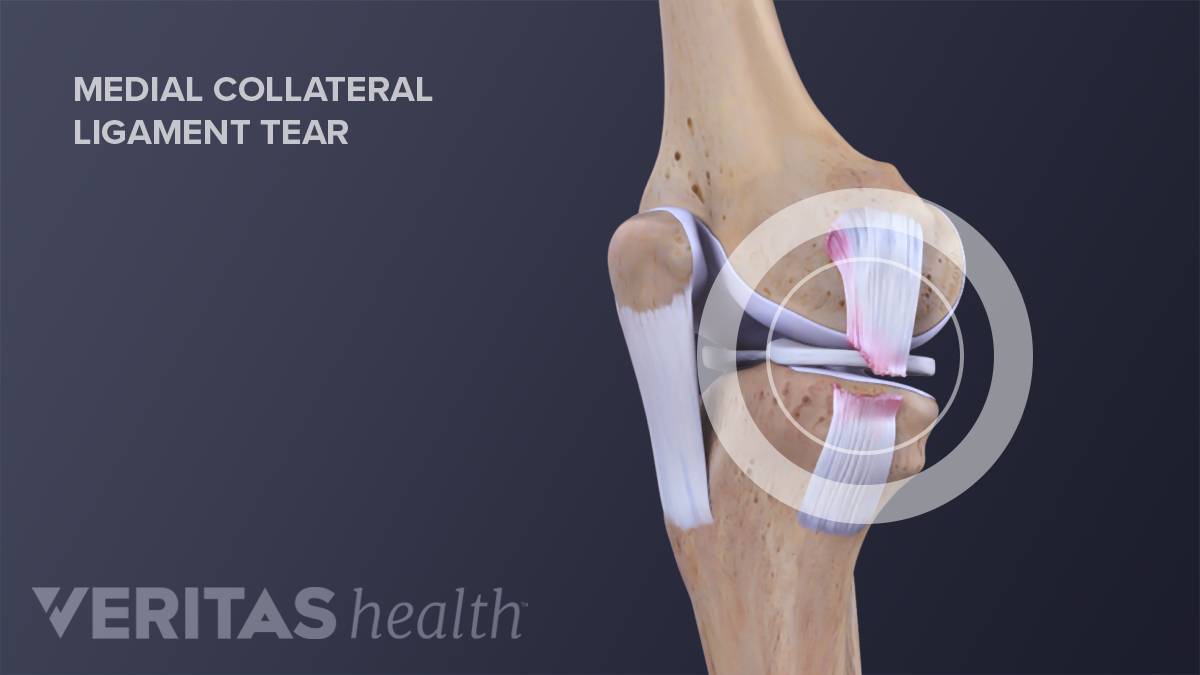 Medial Collateral Ligament (MCL) Tears And Sprains | Sports-health