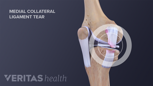 Anterior view of a torn MCL in the knee joint