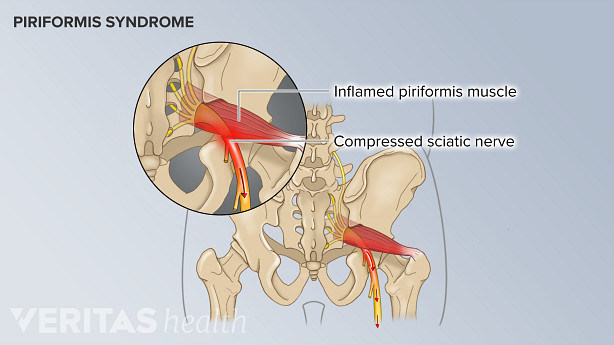 An inflamed piriformis muscle compressing the sciatic nerve in the lower back.