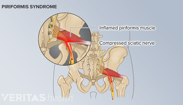 Posterior view of a inflamed piriformis muscle and a compressed sciatic nerve