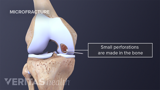 Illustration showing knee joint microfracture from cartilage lesion.