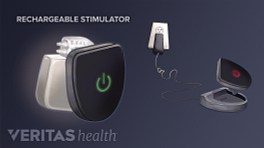 Medical illustration of spinal cord rechargable stimulation