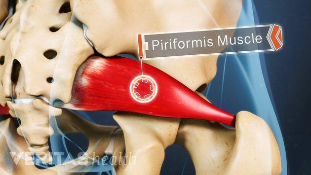 Anterior view of the piriformis muscle in the buttocks