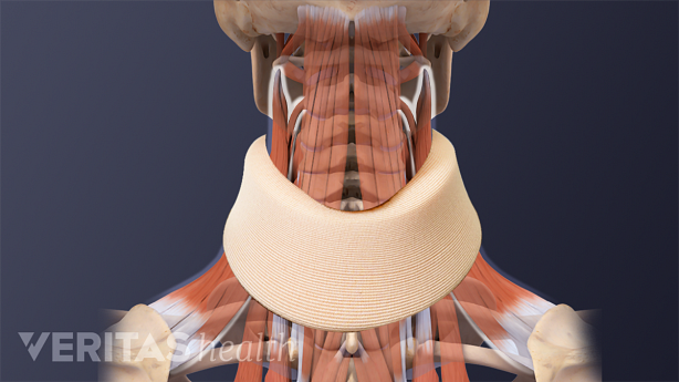 Illustration showing anatomy of the neck with a neck brace.