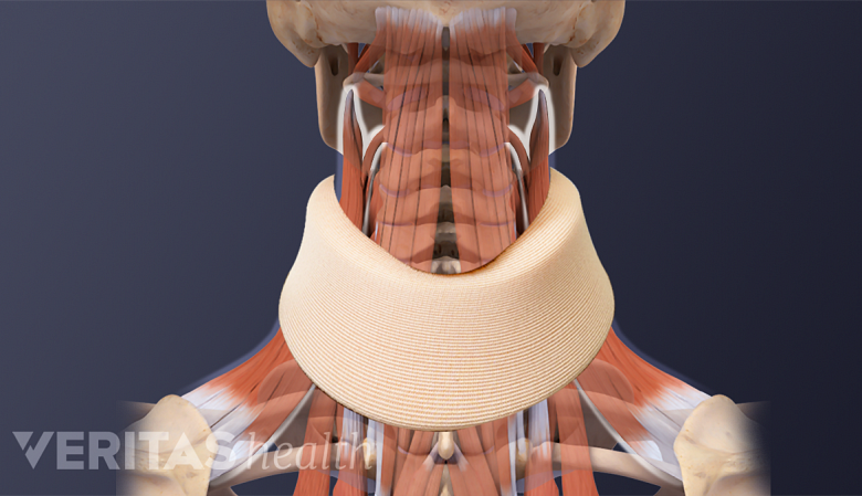 Illustration showing anatomy of the neck with a neck brace.