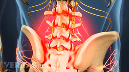 Skeletal view of the lower spine and hips. The lower spine is highlighted in red to indicate pain.