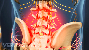 Skeletal view of the lower spine and hips. The lower spine is highlighted in red to indicate pain.