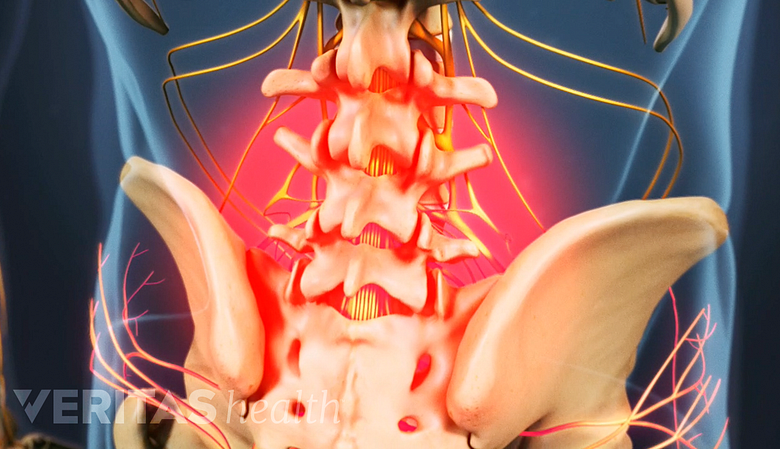 Illustration showing lumbar spine and pelvis highlighted in red.