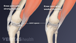 Illustration showing how strong muscles support the knee joint and help maintain healthy joint space between the bones.