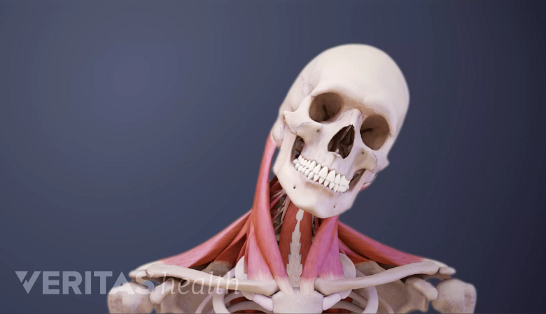 Medical illustration showing stiff neck.