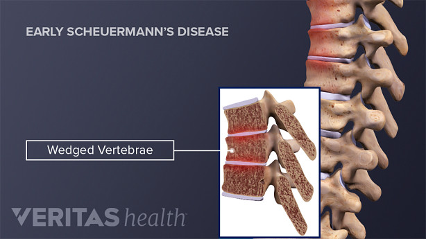 Profile view of a wedged vertebrae in early Scheuermann&#039;s disease.