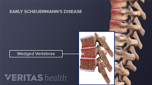Profile view of wedged vertebrae in Early Scheuermann&#039;s Disease