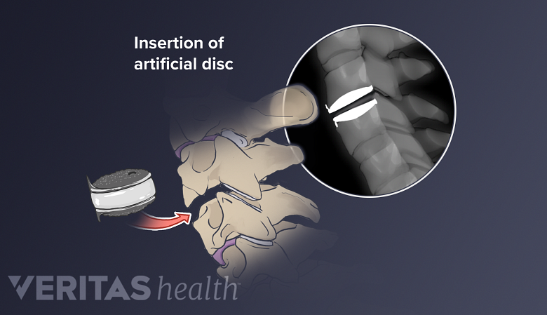 illustration showing insertion of artificial disc into the vertebra.