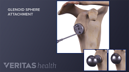 Medical illustration showing glenoid sphere attachment.