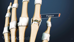 Dorsal view of rheumatoid arthritis pannus in the hand.