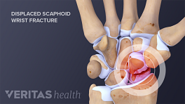 Displaced scaphoid wrist fracture anatomy