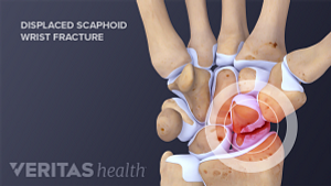 Displaced scaphoid wrist fracture anatomy