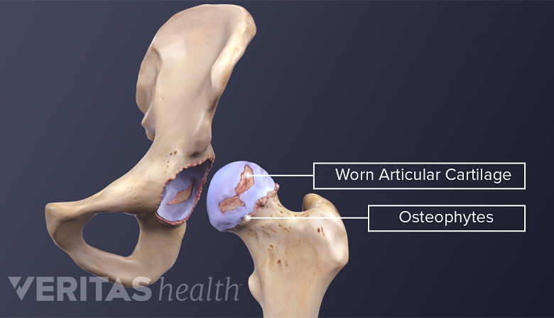 Illustration showing worn cartilage and osteophytes in the hip
