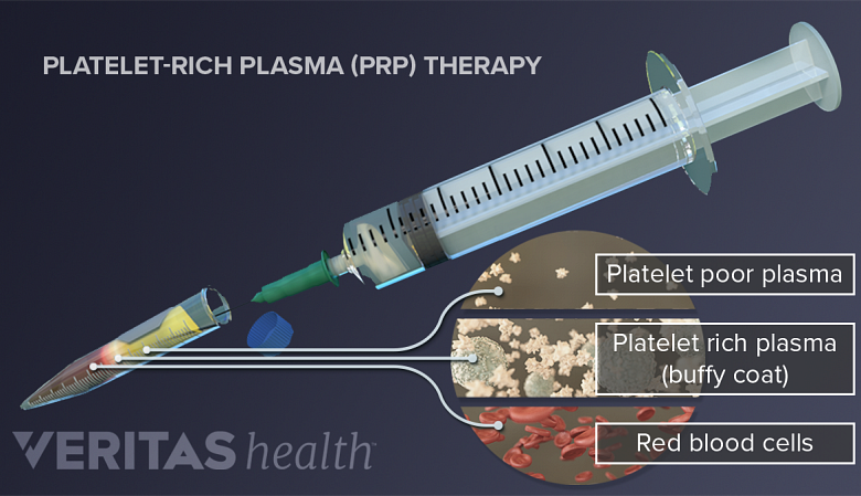The component parts of a platelet-rich plasma injection.