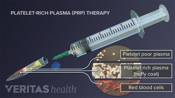 Una ilustración que muestra el contenido de la inyección de plasma rico en plaquetas.