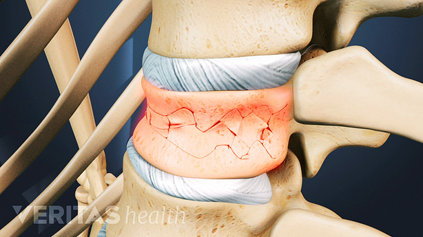 A close up illustration showing fractures in a vertebrae