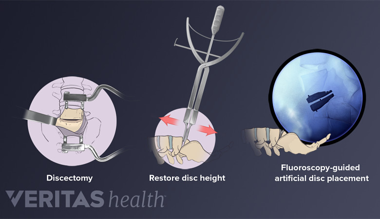 Illustration showing Lumbar artificial disc replacement surgery.