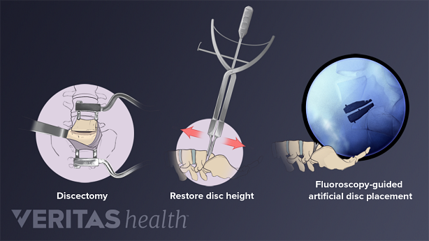 Illustration showing lumbar disc replacement surgery.