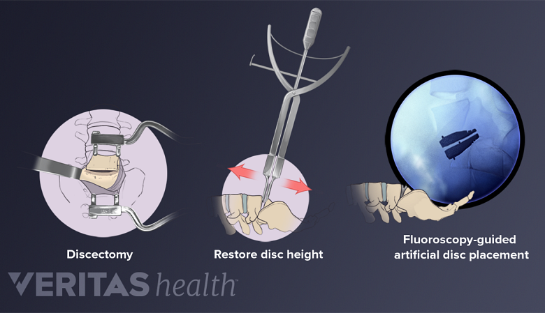 Illustration showing steps in the artificial disc replacement surgery.