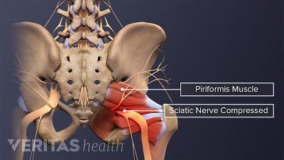 Anatomy of the lower back, pelvic, and hip bones showing an inflamed piriformis muscle and a compressed sciatic nerve on the right side.