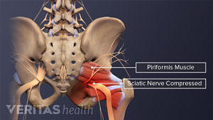 Illustration of the lower spine and pelvis highlighting the piriformis muscle and a compressed sciaitc nerve.