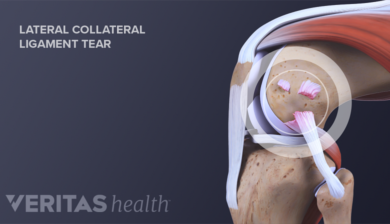Illustration knee joint anatomy showing torn LCL.