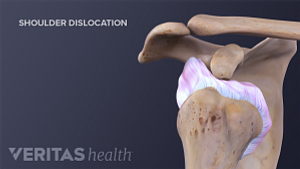 Anterior view of a dislocated shoulder