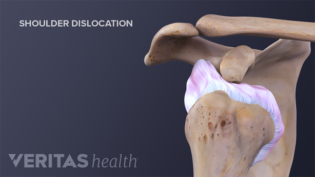 Anterior dislocation of the shoulder