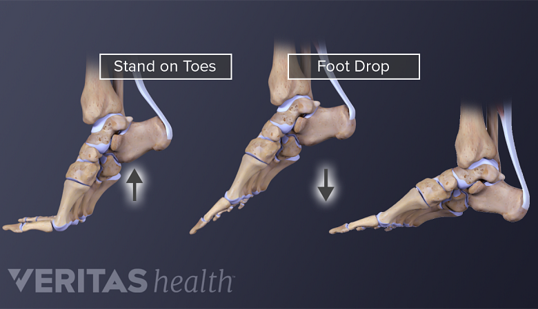 Anatomy of feet showing stand on toes, foot drop and achilles tendon.
