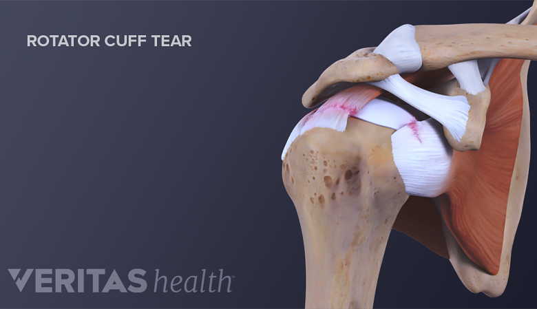 Anatomic description of degenerative rotator cuff tear. The common site