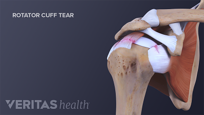 肩关节的前视图显示肌腱套撕裂。