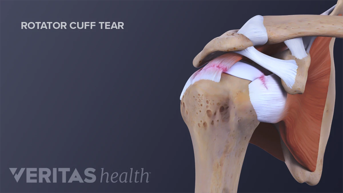 Common Sports-Related Injuries | Sports-health