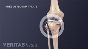 Medical illustration showing the cuts in the tibia as part of a tibial osteotomy surgery