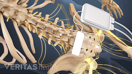 Complications of Spinal Cord Stimulator  All Star Pain Management &  Regenerative Medicine